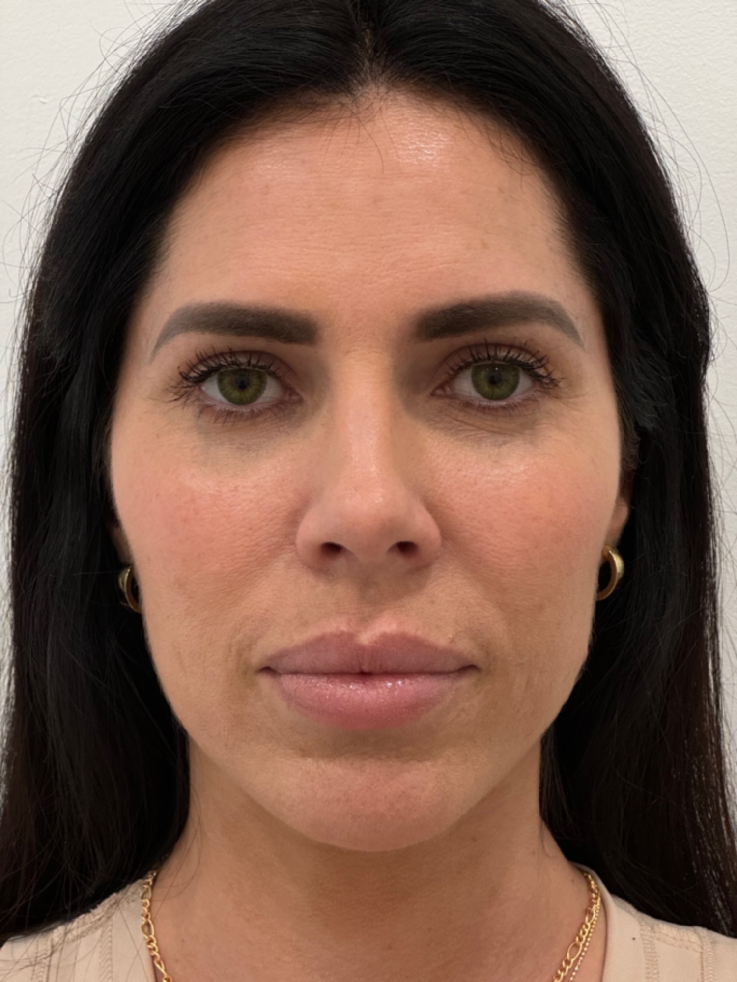 Skin Plus Beauty wrinkle relaxer results