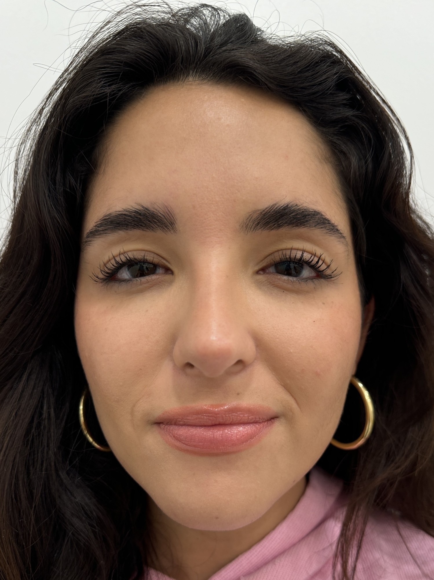 Skin Plus Beauty wrinkle relaxer results