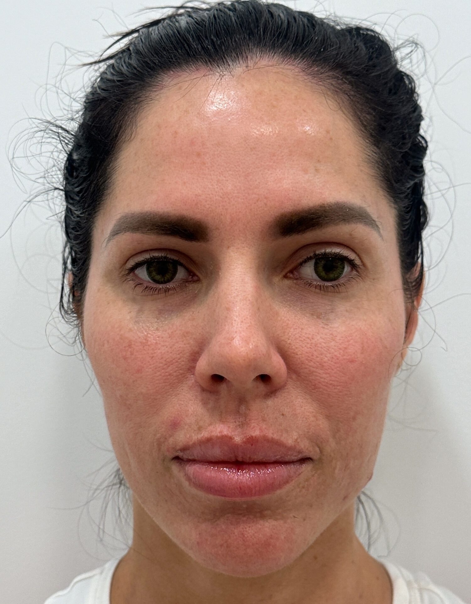 Skin Plus Beauty wrinkle relaxer results