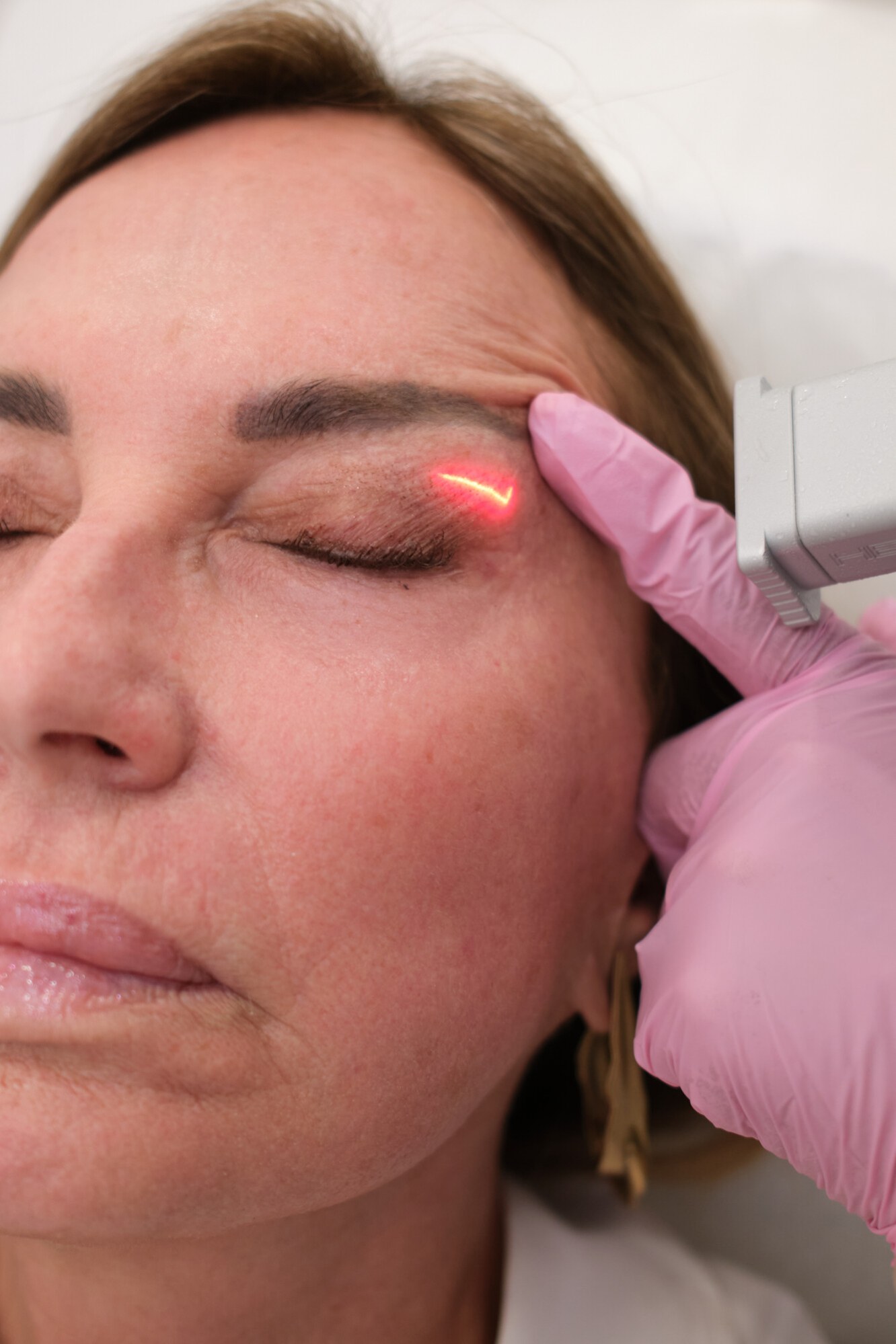 CO2 eye resurfacing at Skin Plus Beauty