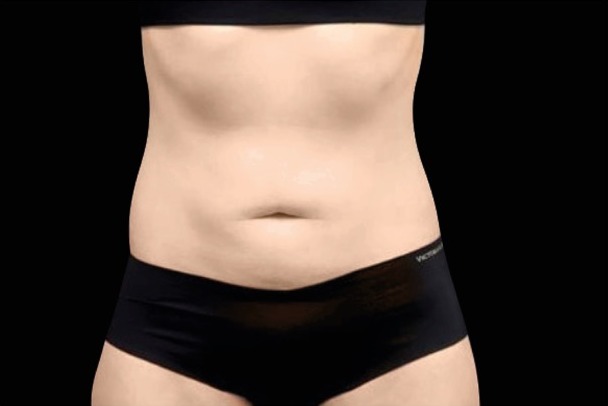 Emsculpt NEO after treatment, female abdomen, front view