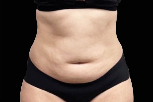Emsculpt NEO before treatment, female abdomen, front view
