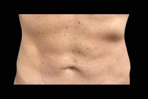 Emsculpt NEO after treatment, female abdomen, front view