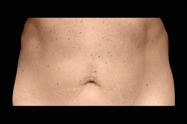 Emsculpt NEO before treatment, female abdomen, front view