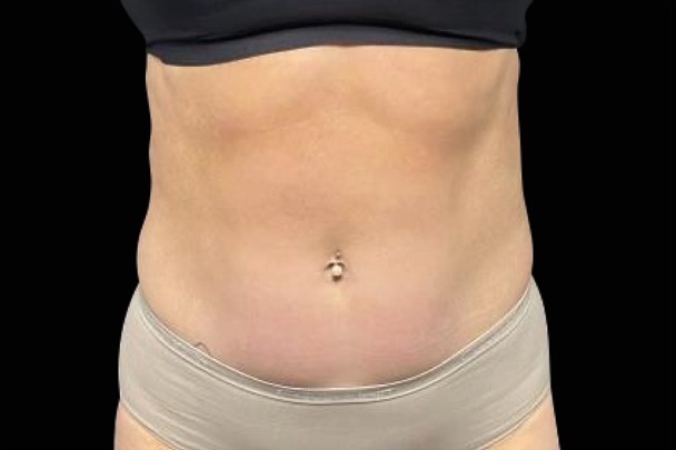 Emsculpt NEO after treatment, female abdomen, front view
