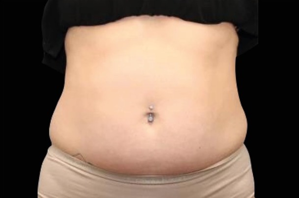 Emsculpt NEO before treatment, female abdomen, front view