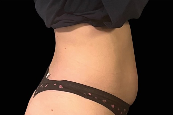 Emsculpt NEO after treatment, female abdomen, front view
