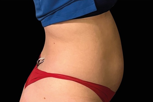 Emsculpt NEO before treatment, female abdomen, front view