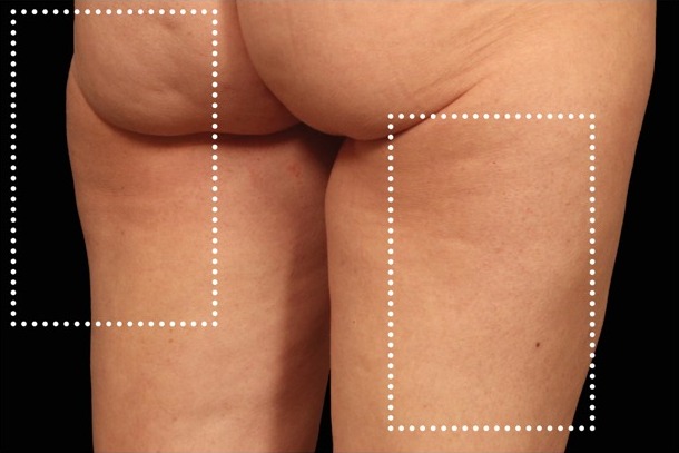 Emsculpt NEO after treatment