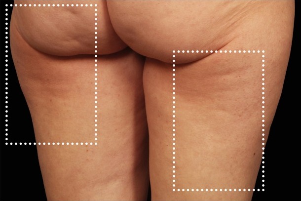Emsculpt NEO before treatment