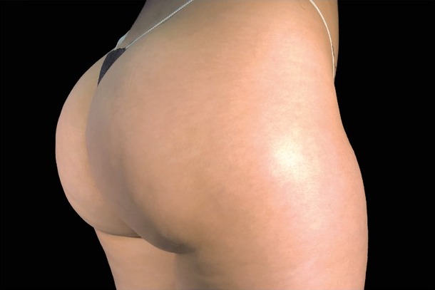 Emsculpt NEO after treatment