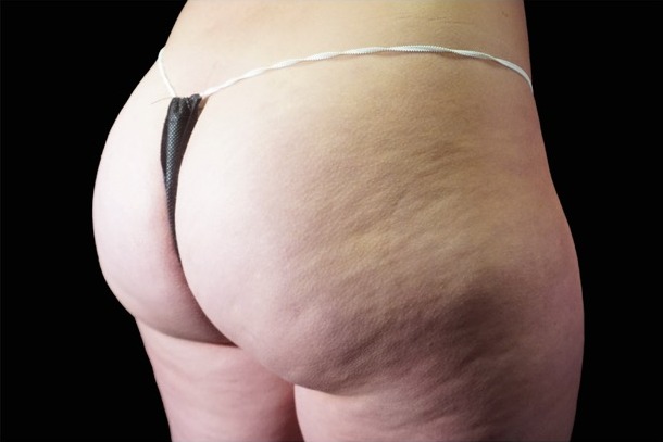 Emsculpt NEO before treatment