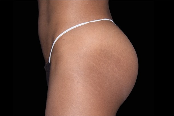 Emsculpt NEO after treatment