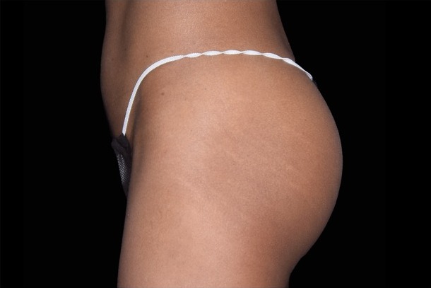 Emsculpt NEO before treatment