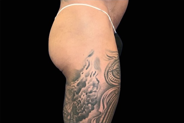 Emsculpt NEO before treatment