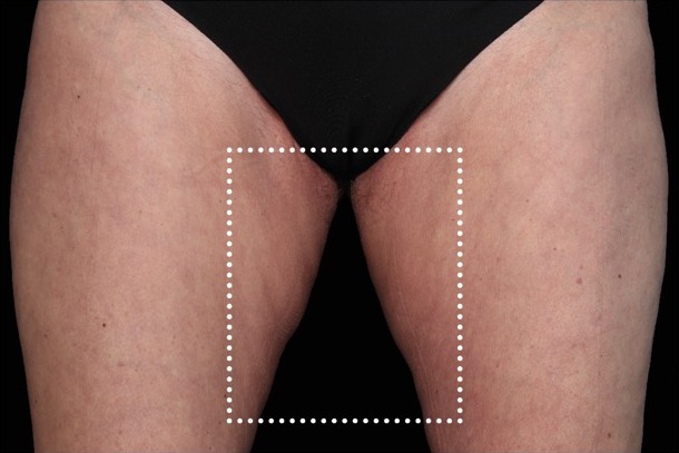 Emsculpt NEO after treatment