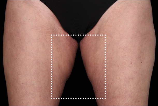 Emsculpt NEO before treatment