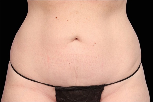 Emsculpt NEO after treatment