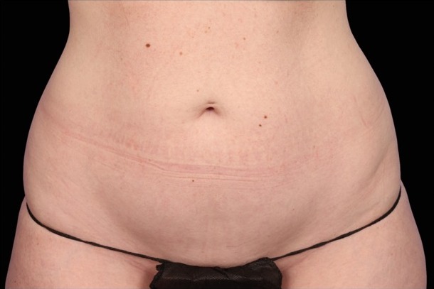 Emsculpt NEO before treatment