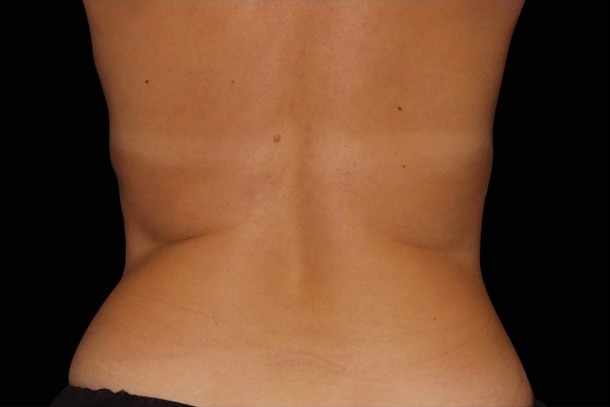 Emsculpt NEO after treatment