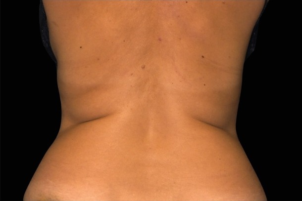 Emsculpt NEO before treatment
