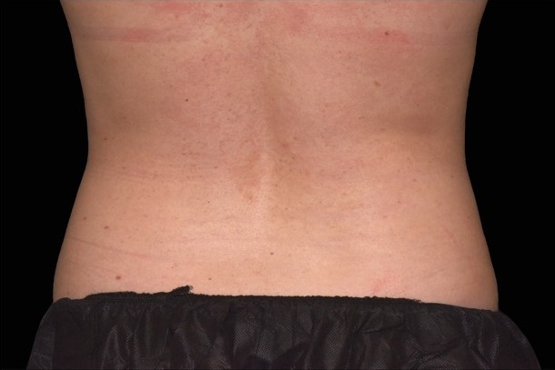 Emsculpt NEO after treatment