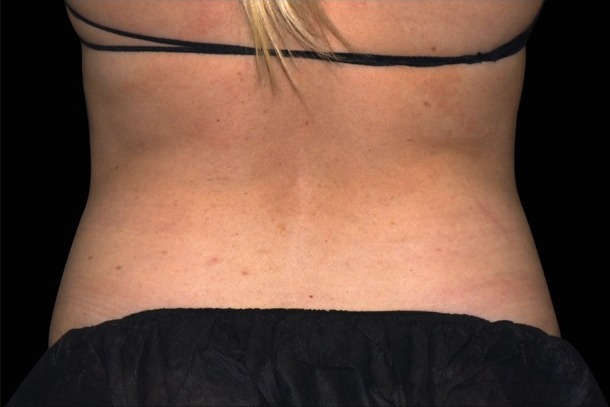 Emsculpt NEO before treatment