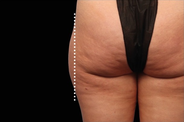 Emsculpt NEO after treatment
