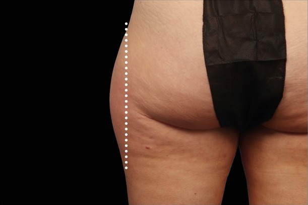 Emsculpt NEO before treatment