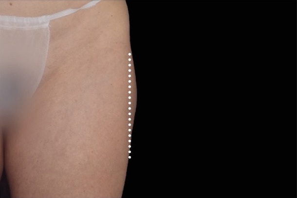 Emsculpt NEO after treatment
