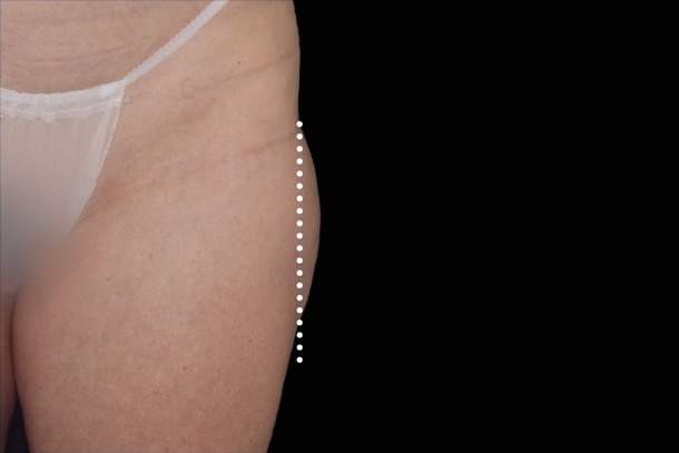 Emsculpt NEO before treatment