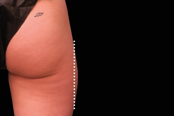 Emsculpt NEO after treatment