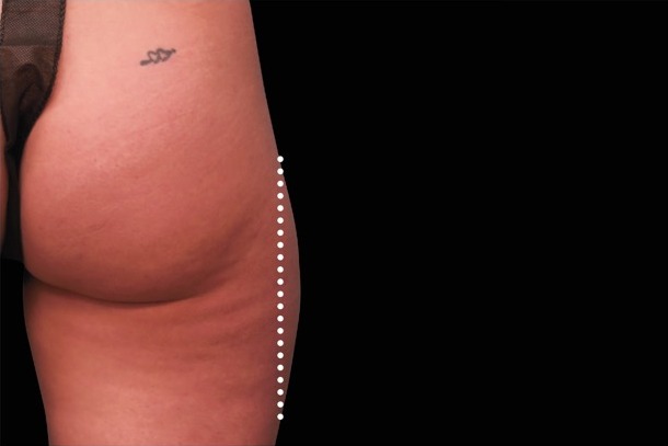 Emsculpt NEO before treatment