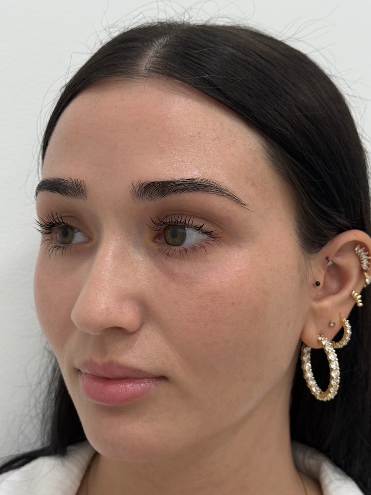 CoolPeel CO2 laser result 1 — after — Skin Plus Beauty client
