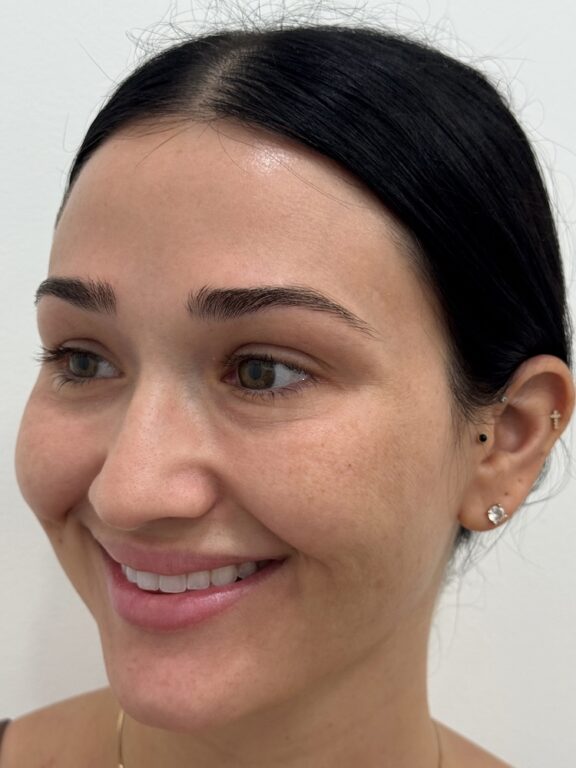 CoolPeel CO2 laser result 1 — before — Skin Plus Beauty client