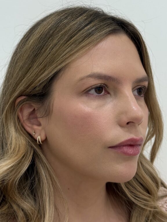 CoolPeel CO2 laser result 2 — after — Skin Plus Beauty client