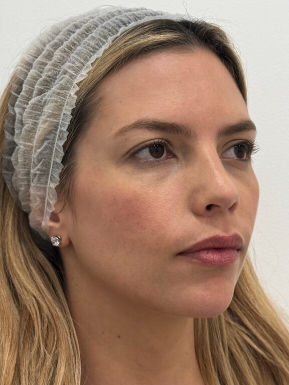 CoolPeel CO2 laser result 2 — before — Skin Plus Beauty client