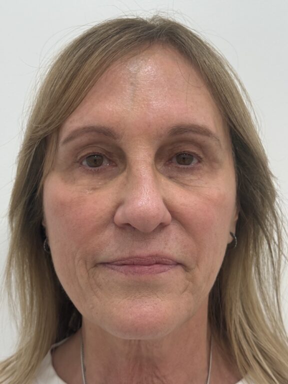 CoolPeel CO2 laser result 3 — after — Skin Plus Beauty client