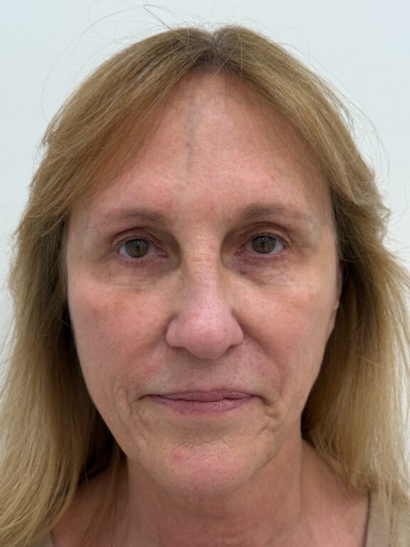 CoolPeel CO2 laser result 3 — before — Skin Plus Beauty client