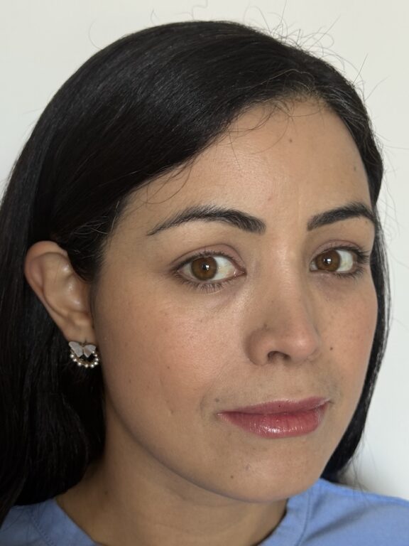 CoolPeel CO2 laser result 4 — after — Skin Plus Beauty client