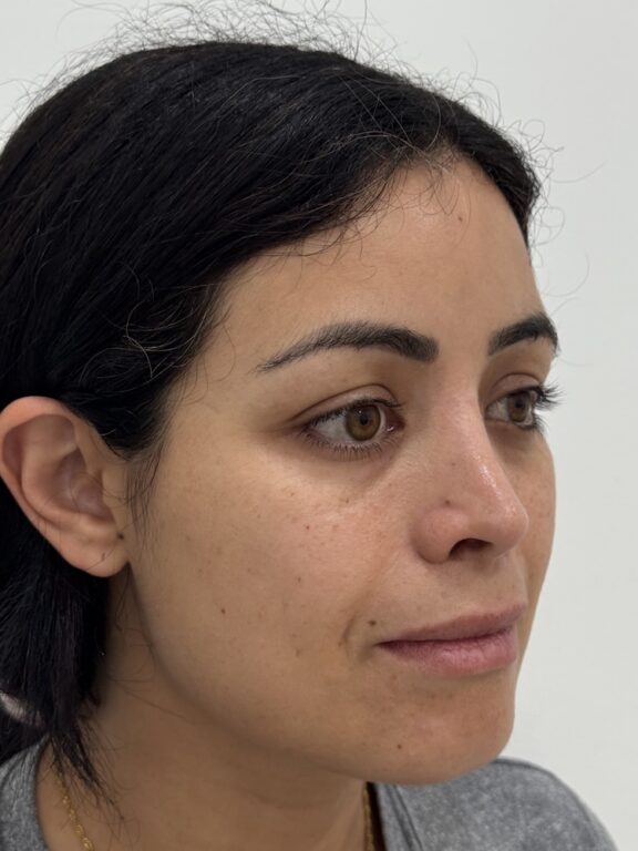 CoolPeel CO2 laser result 4 — before — Skin Plus Beauty client
